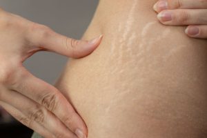 Young woman showing stretch marks on her body